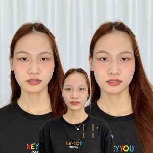 khử thâm môi an trứng được không