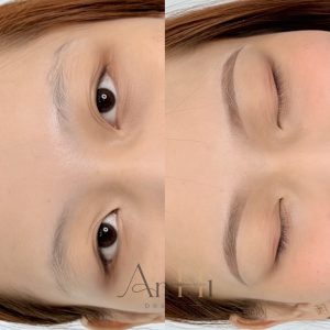 17 tuổi khử thâm môi được không Quận 9 - Thủ Đức