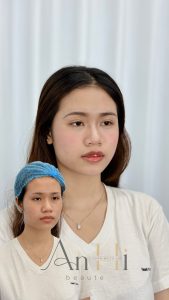 bệnh viện da liễu có khử thâm môi không Quận 9 - Thủ Đức