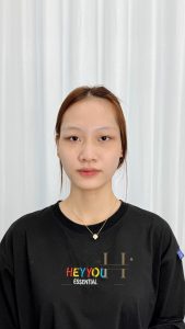chi phí khử thâm môi Quận 9 - Thủ Đức