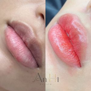 khử thâm môi ăn ốc được không Quận 9 - Thủ Đức
