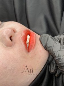 khử thâm môi bằng laser có hiệu quả không Quận 9 - Thủ Đức
