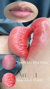 khử thâm môi có ăn trứng được không Quận 9 - Thủ Đức