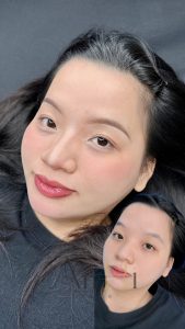 khử thâm môi có bị sưng không Quận 9 - Thủ Đức