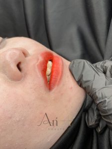 khử thâm môi da liễu Quận 9 - Thủ Đức