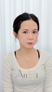 khử thâm môi kiêng ăn bao lâu Quận 9 - Thủ Đức