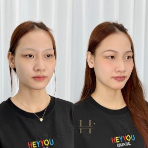 khử thâm môi mất bao nhiêu tiền Quận 9 - Thủ Đức