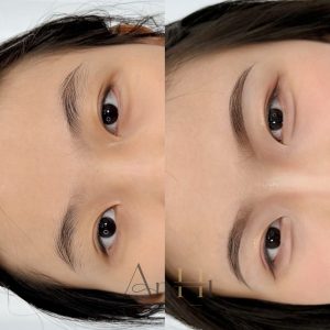 khử thâm môi nhấn lòng Quận 9 - Thủ Đức