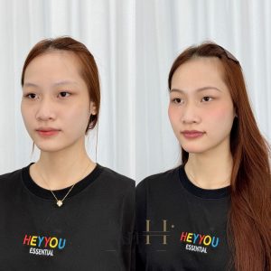 khử thâm môi ở bệnh viện da liễu Quận 9 - Thủ Đức