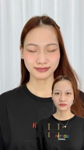 khử thâm môi ở đâu tốt Quận 9 - Thủ Đức