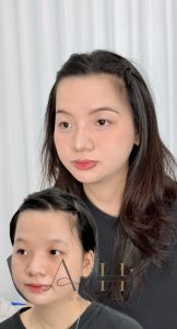 khử thâm môi pico laser Quận 9 - Thủ Đức