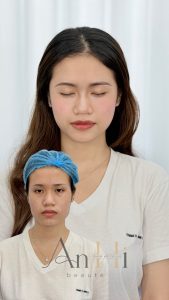 khử thâm môi quận 12 Quận 9 - Thủ Đức