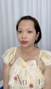 khử thâm môi tại nhà Quận 9 - Thủ Đức