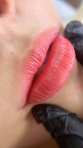 kỹ thuật khử thâm môi Quận 9 - Thủ Đức