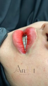 laser khử thâm môi Quận 9 - Thủ Đức