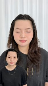 lưu ý khi khử thâm môi Quận 9 - Thủ Đức