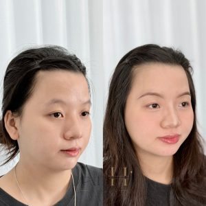 mấy tuổi khử thâm môi được Quận 9 - Thủ Đức