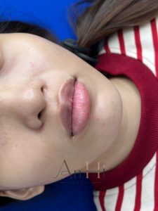 phương pháp khử thâm môi Quận 9 - Thủ Đức