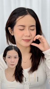 quá trình khử thâm môi Quận 9 - Thủ Đức