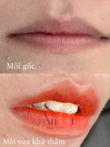 quy trình sau khi khử thâm môi Quận 9 - Thủ Đức
