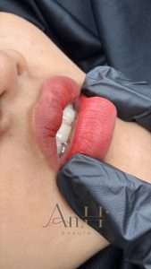 sau khi khử thâm môi cần kiêng gì Quận 9 - Thủ Đức
