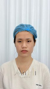 sau khi khử thâm môi Quận 9 - Thủ Đức
