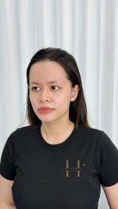 tác hại của khử thâm môi Quận 9 - Thủ Đức