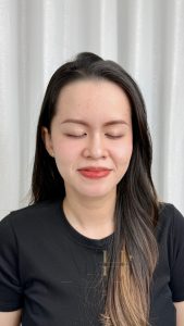 tiêm filler có khử thâm môi được không Quận 9 - Thủ Đức